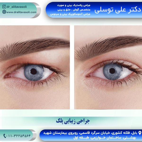 جراحی زیبایی پلک