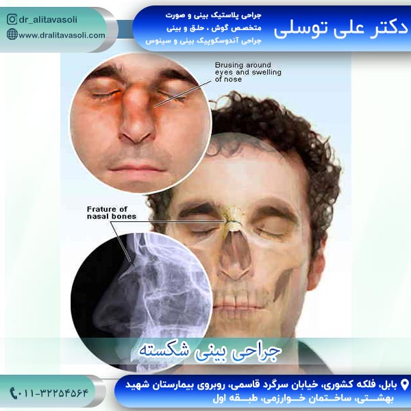 جراحی بینی شکسته