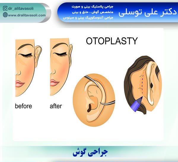 جراحی گوش در بابل