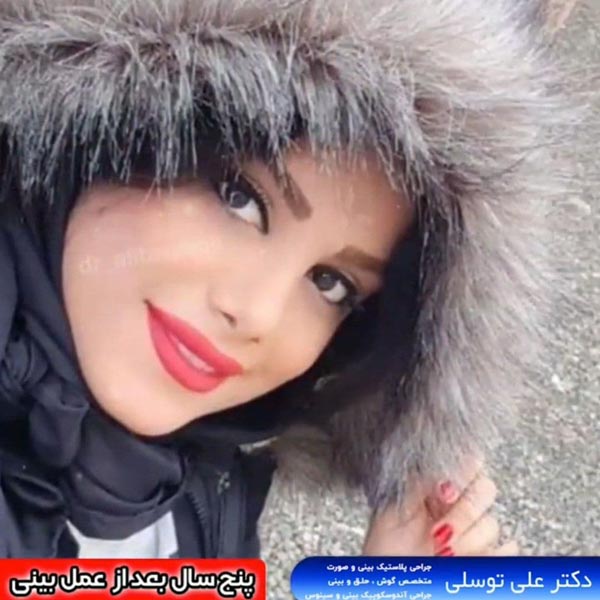 جراحی بینی استخوانی