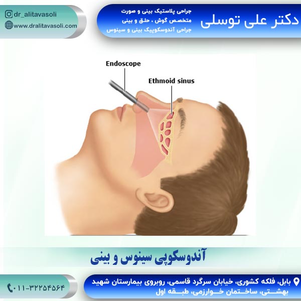 آندوسکوپی سینوس و بینی