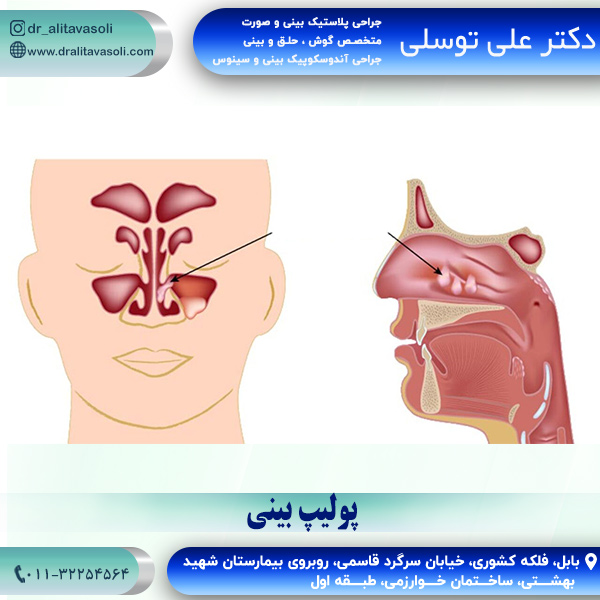 عکس پولیپ بینی