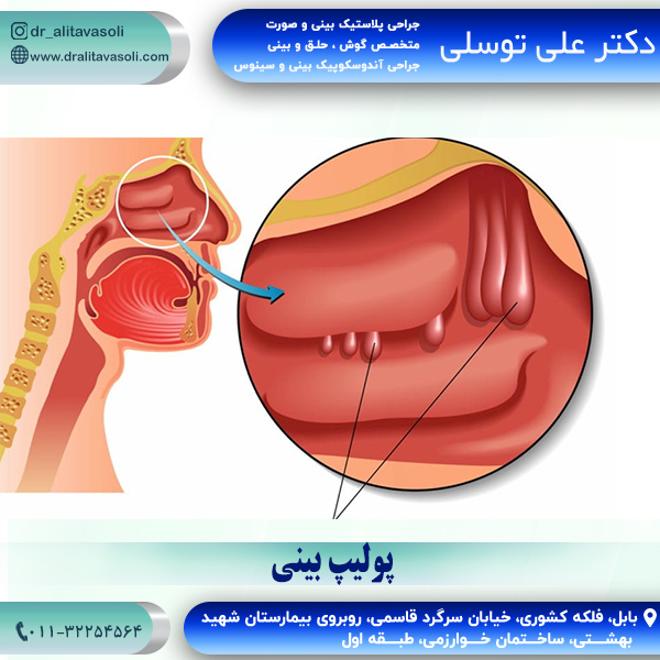 پولیپ بینی