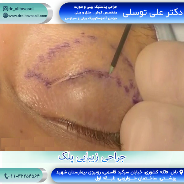جراحی زیبایی پلک
