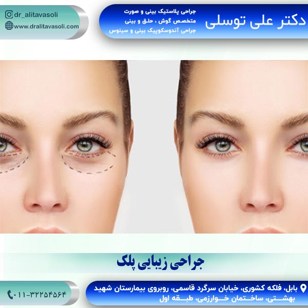جراحی زیبایی پلک