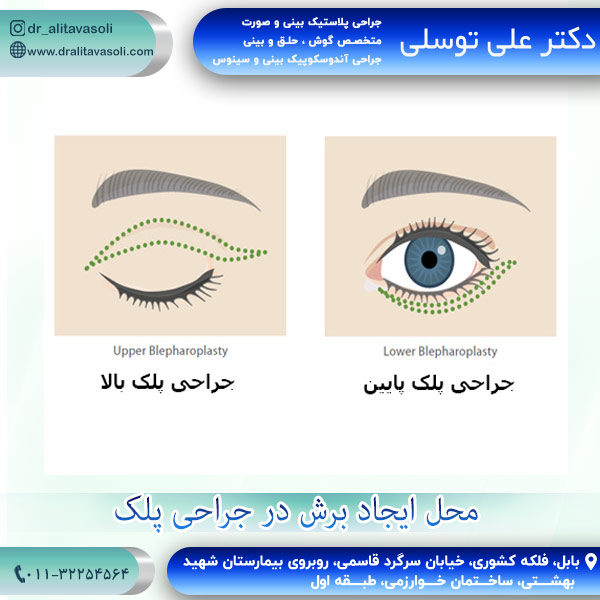 جراحی زیبایی پلک
