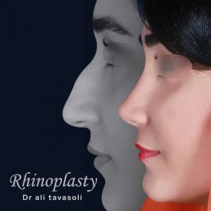 جراحی بینی در شمال
