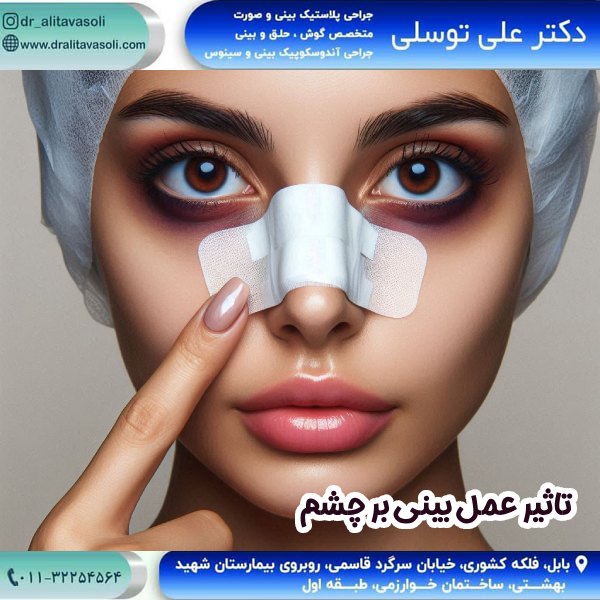 تأثیر عمل بینی بر چشم‌ ها - دکتر علی توسلی