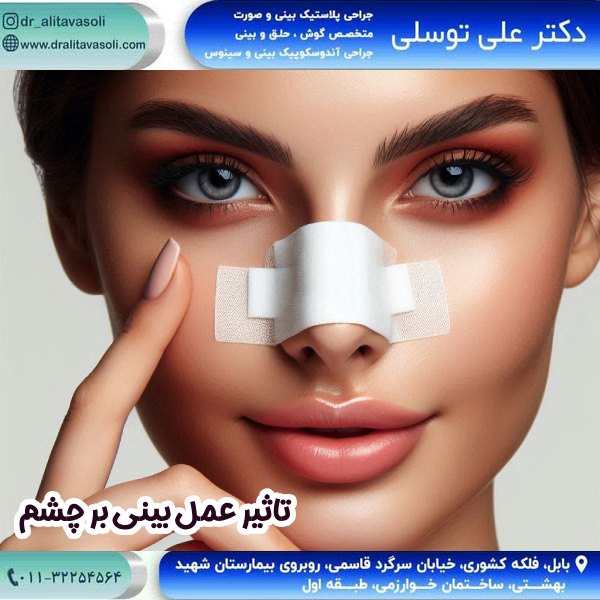 تأثیر عمل بینی بر چشم‌ ها - دکتر علی توسلی