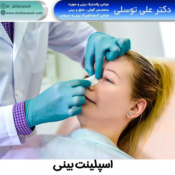اسپلینت بینی - دکتر علی توسلی