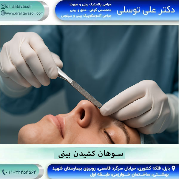 سوهان کشیدن بینی بعد از عمل
