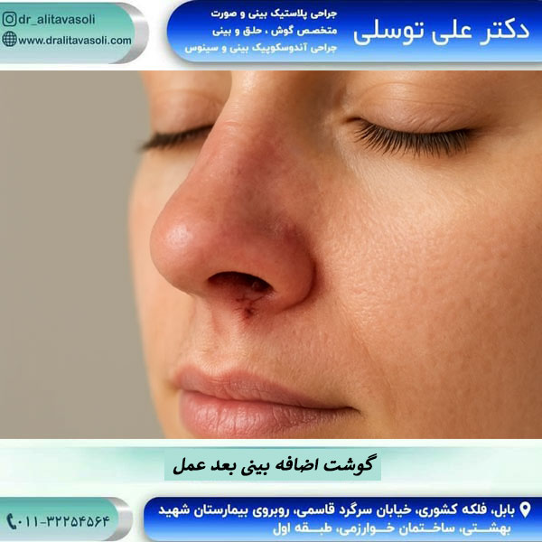 گوشت اضافه بینی بعد از جراحی بینی
