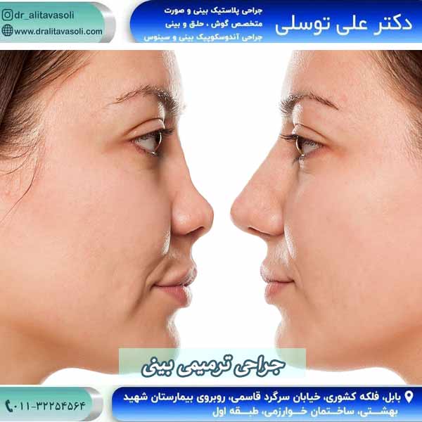 جراحی ترمیمی بینی