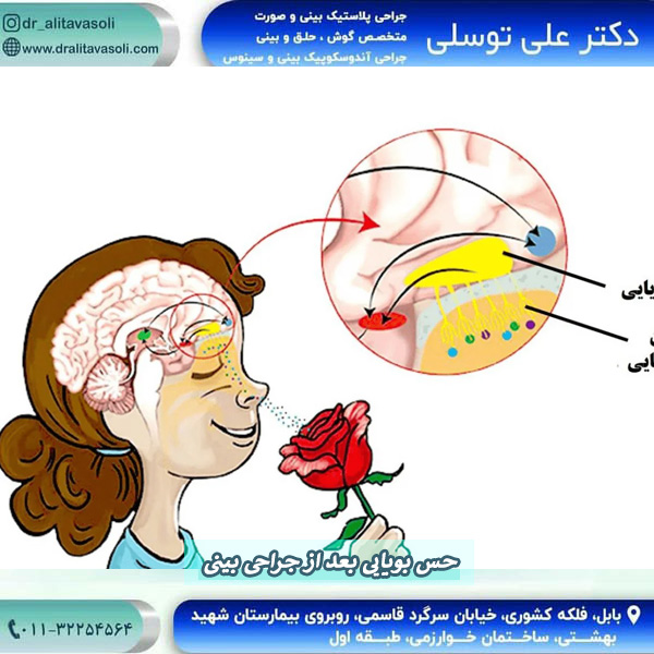 از بین رفتن حس بویایی بعد از جراحی بینی