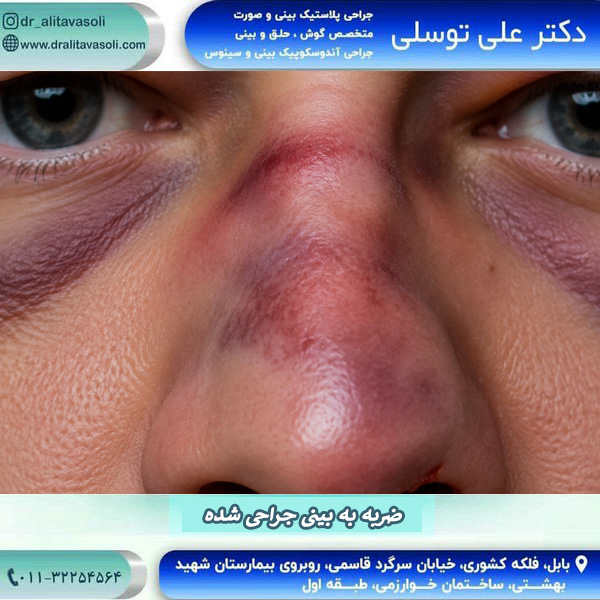 ضربه به بینی جراحی شده