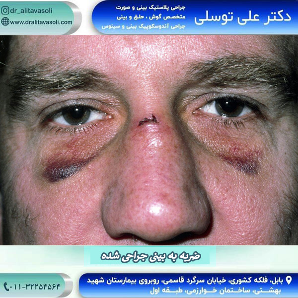 ضربه به بینی عمل شده