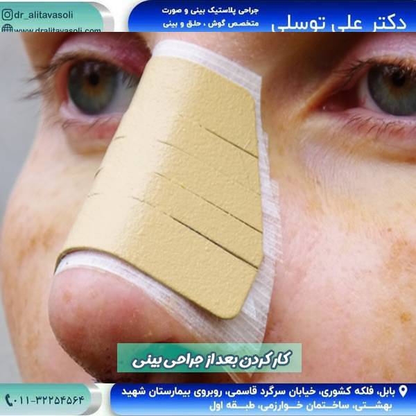 کار کردن بعد از جراحی بینی