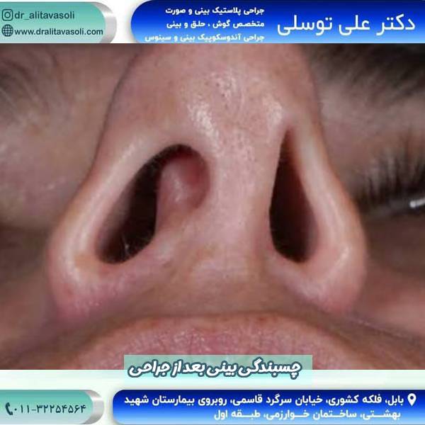 چسبندگی بینی بعد از جراحی