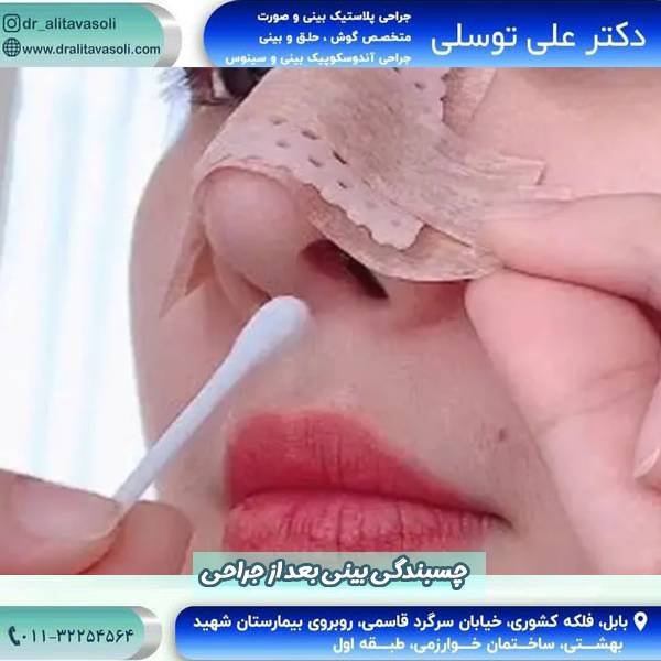 چسبندگی بینی بعد از جراحی