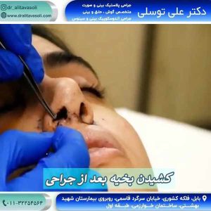 کشیدن بخیه بعد از جراحی بینی