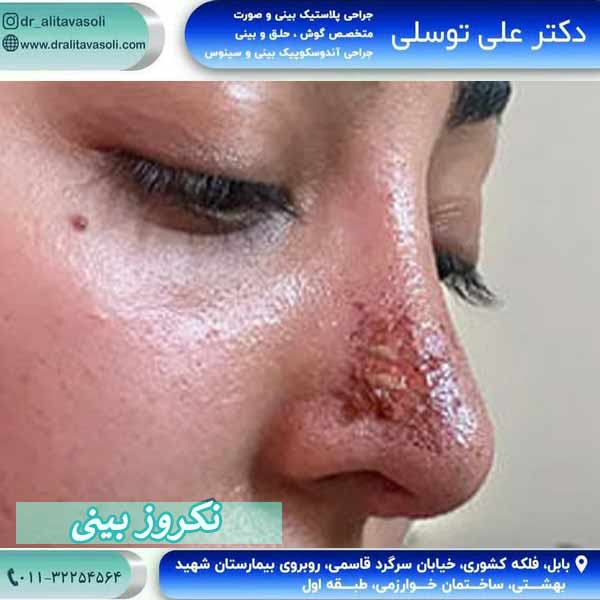 نکروز بینی