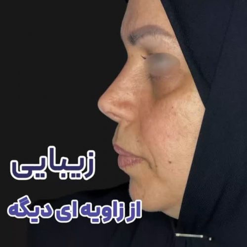 جراحی-بینی-501