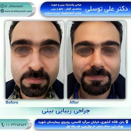 جراحی-بینی-1