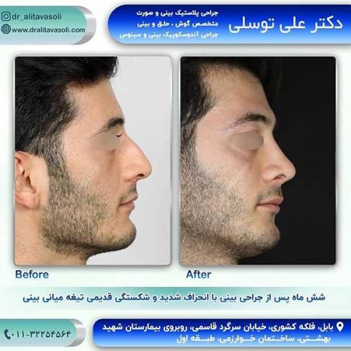 جراحی-بینی-100