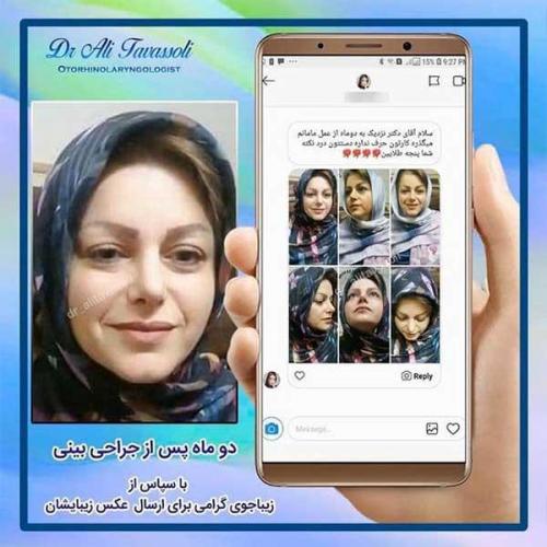 جراحی-بینی-101