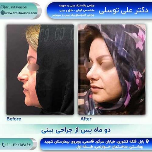 جراحی-بینی-113