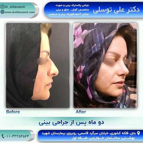 جراحی-بینی-114