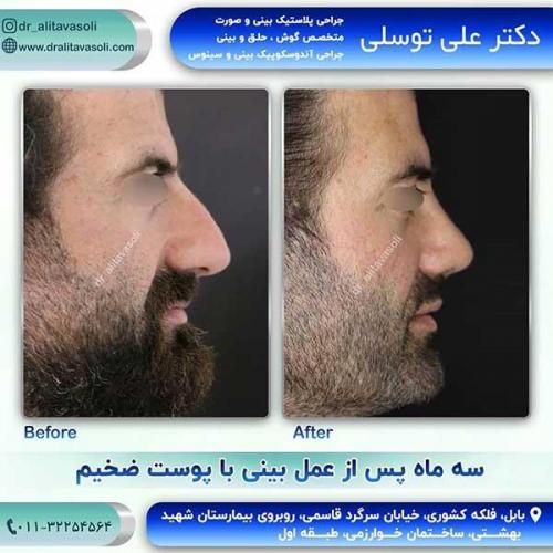 جراحی-بینی-118