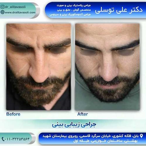 جراحی-بینی-130