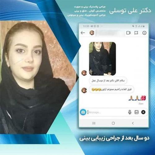 جراحی-بینی-136