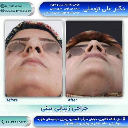 جراحی-بینی-14