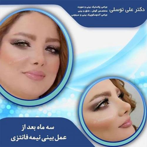 جراحی-بینی-145