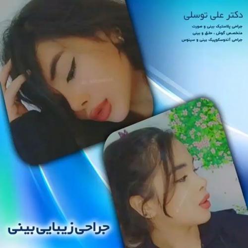 جراحی-بینی-151