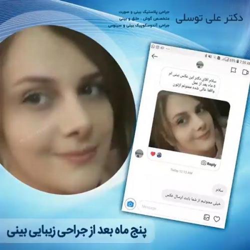 جراحی-بینی-163