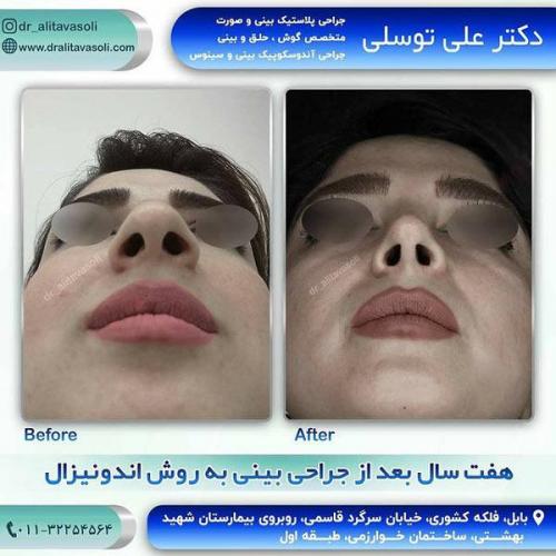 جراحی-بینی-186