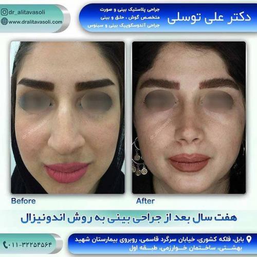 جراحی-بینی-188