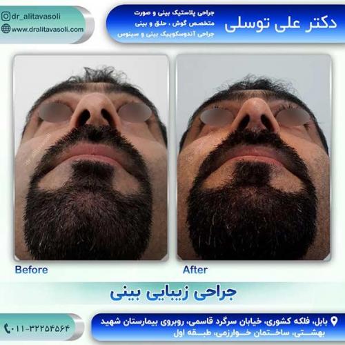 جراحی-بینی-2