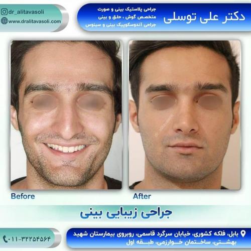 جراحی-بینی-220