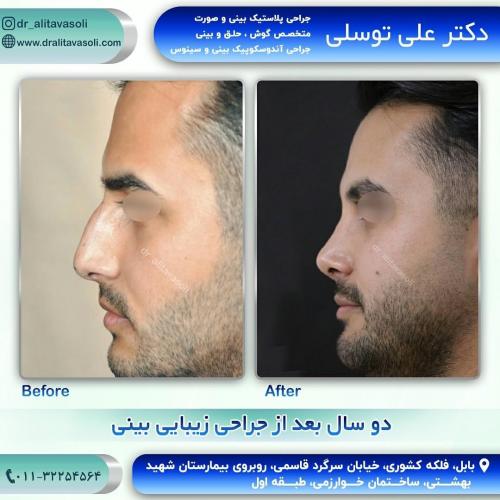 جراحی-بینی-224