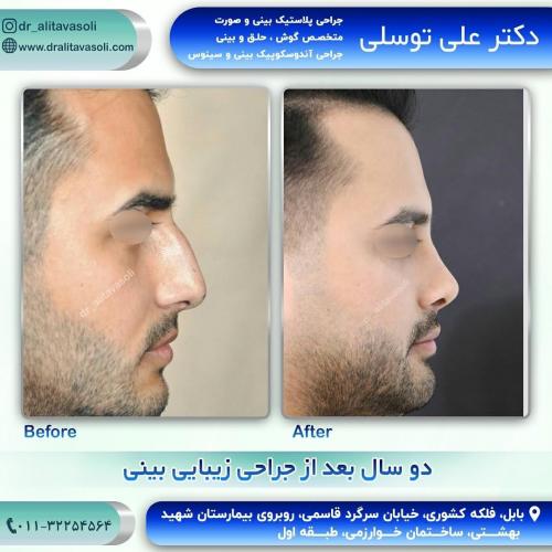 جراحی-بینی-225