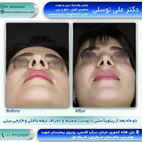 جراحی-بینی-232