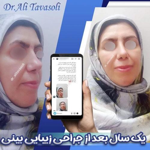 جراحی-بینی-235
