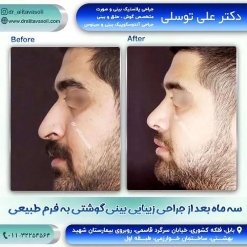 جراحی-بینی-236