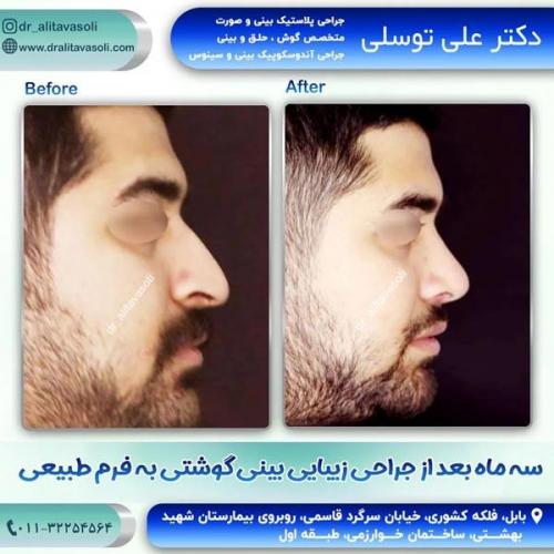 جراحی-بینی-237