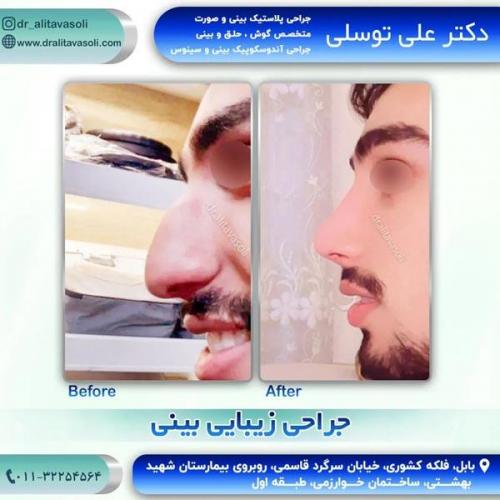 جراحی-بینی-240