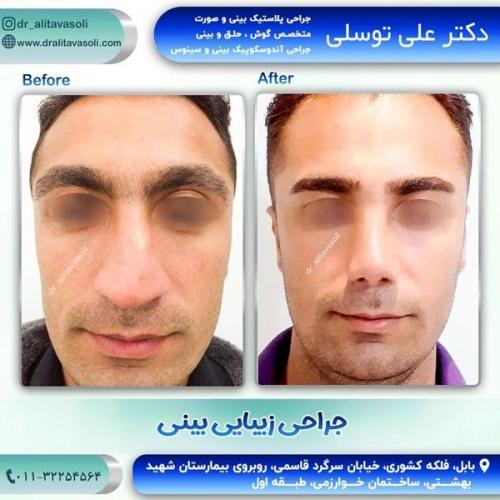جراحی-بینی-241